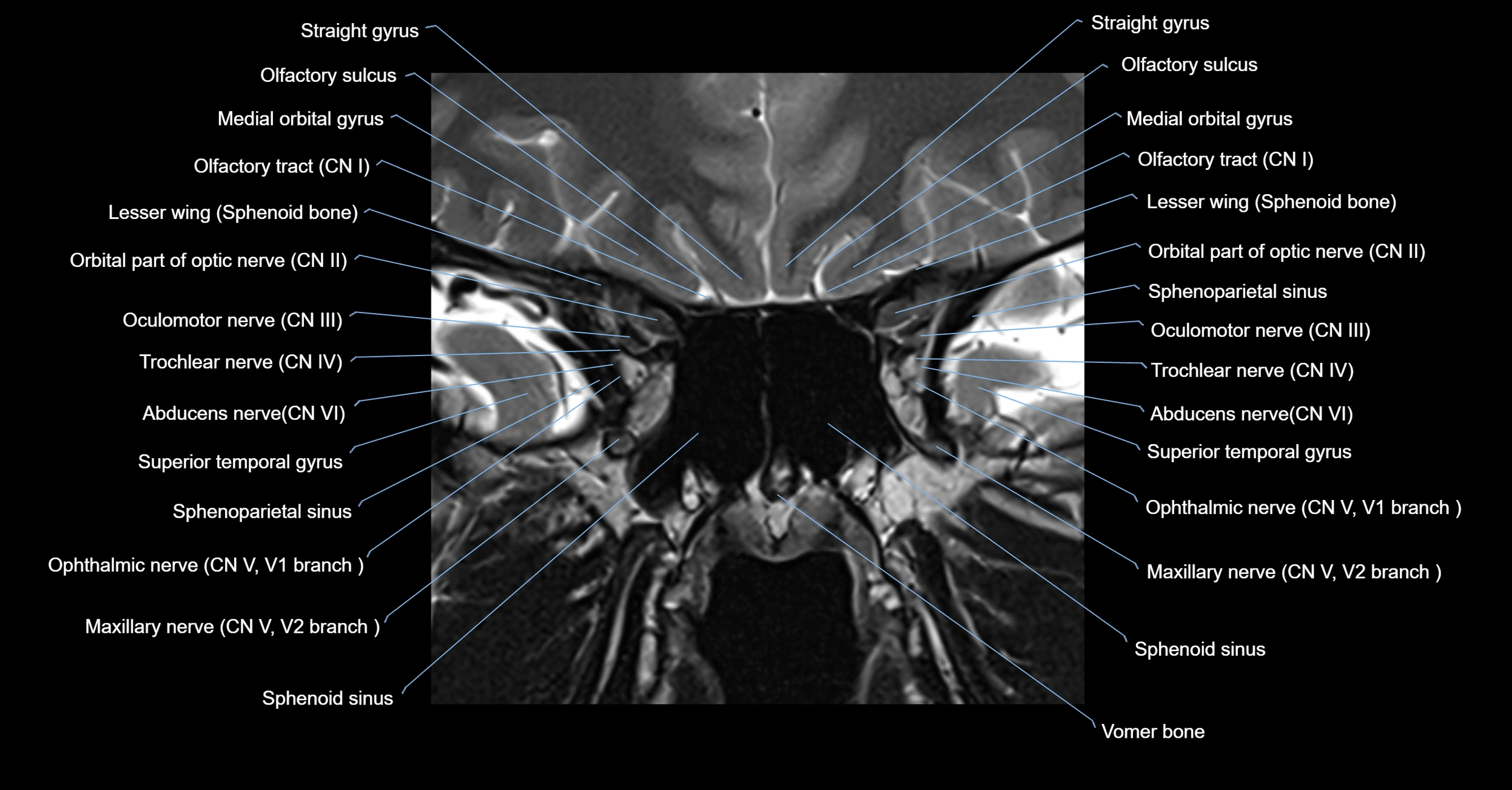 MRI cavernous sinus coronal cross sectional 3T anatomy image-img-00001-00001.webp